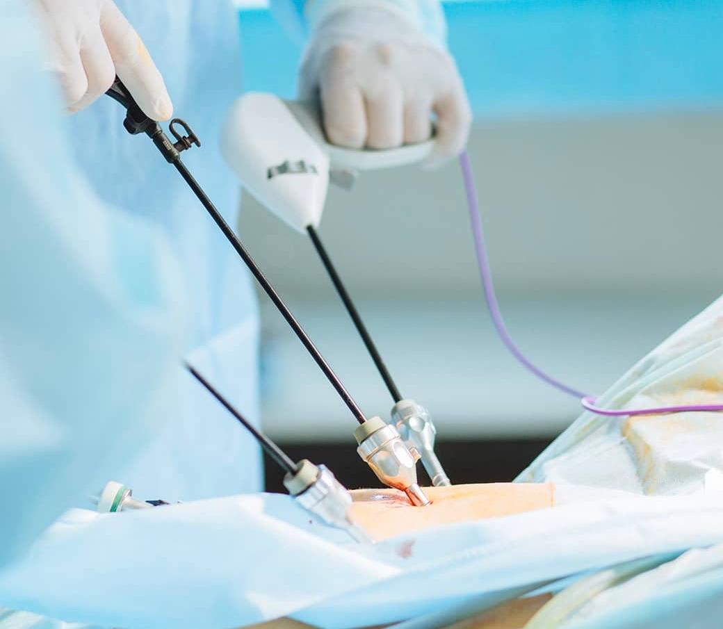 Laparoscopy